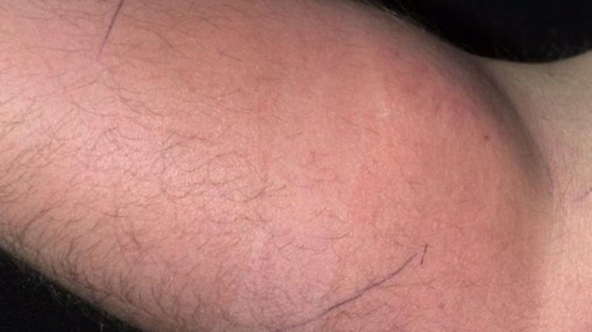 Man Hospitalized After 18 Months of Injecting Semen Into Arm for Pain Relief