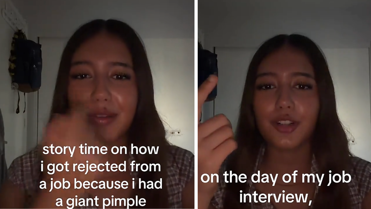 Woman Rejected for Job After Interview Over Pimple: ‘We Take Pride in Appearance’