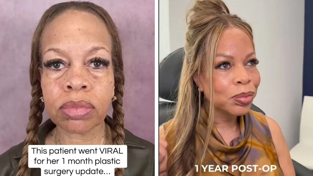 Student’s ‘Are You Old?’ Question Prompts 57-Year-Old Educator’s Viral Facial Rejuvenation Before-and-After